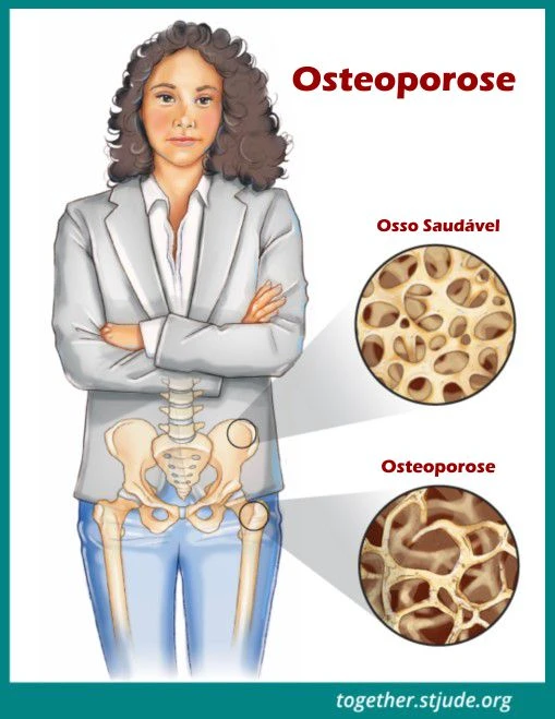 Osteoporose em Mulheres